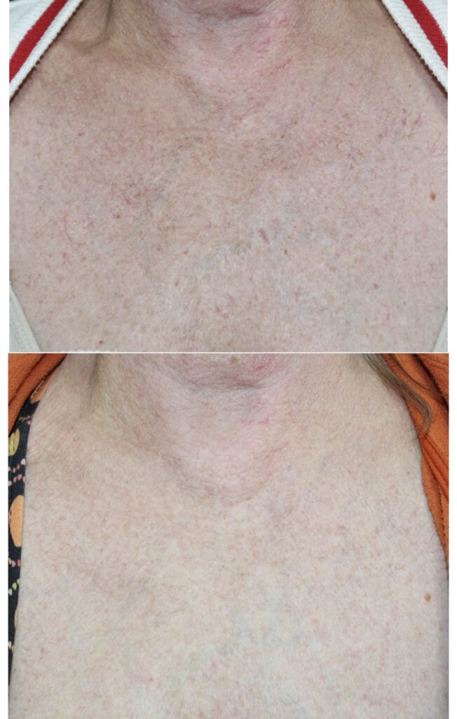 IPL pigment och kärl